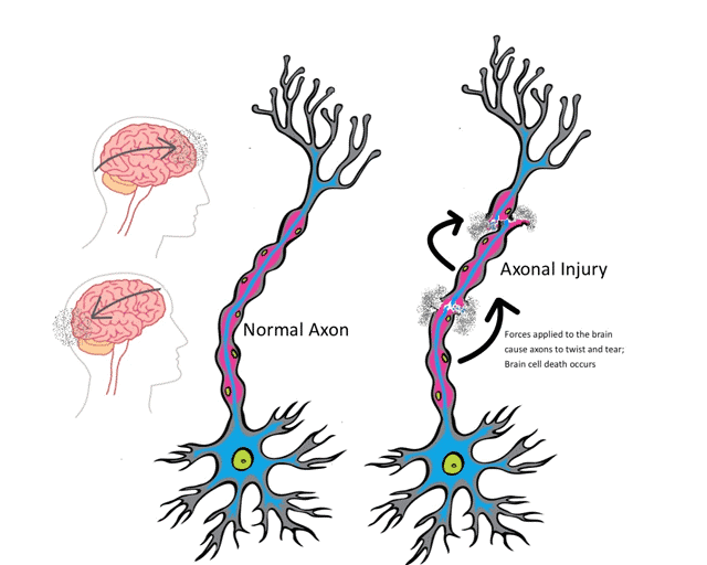 Axon twisting after an impact