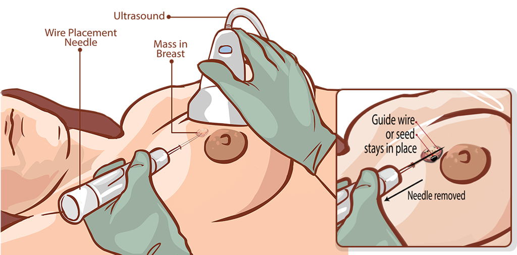 Guided by an ultrasound, a radiologist uses a wire placement needle to insert a wire or seed close to the mass in a breast