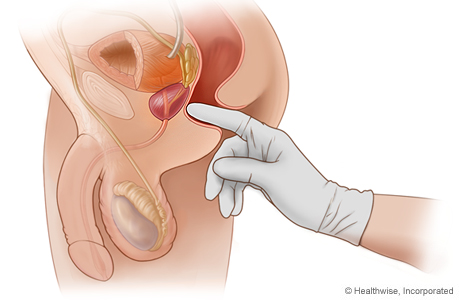 Gloved finger inserted into the anus.